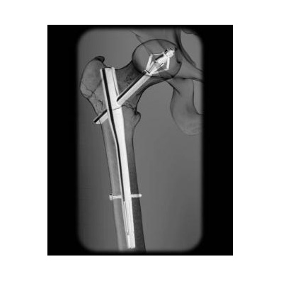 X-Bolt Nail: image from X-Bolt